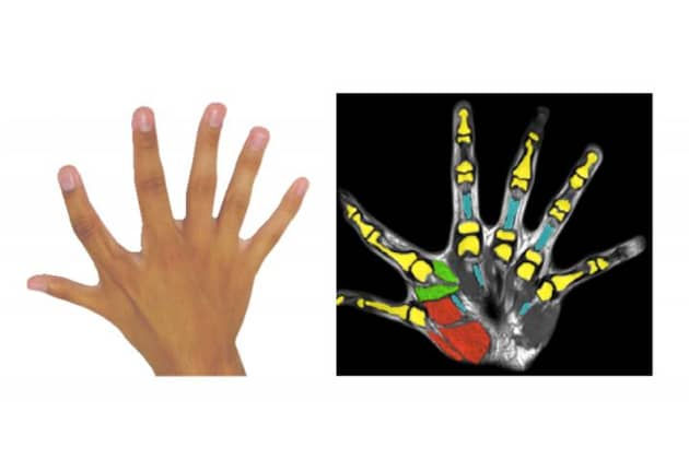 Imagem ilustrando como é a mão de alguém que sofre de Polidactilia, como o baiano "Hexa" de seis dedos.